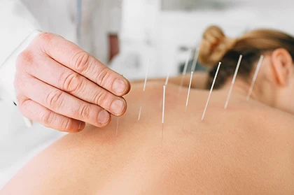 Acupuncture